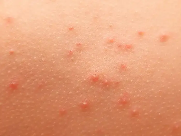 Alergia pokarmowa objawy na skórze – rozpoznaj niebezpieczne symptomy