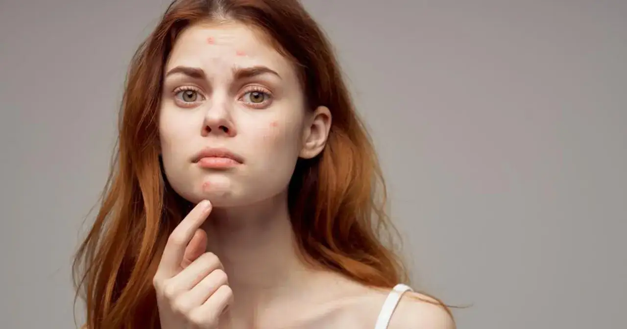 Kobieta z pryszczami na twarzy, dotykająca brody.