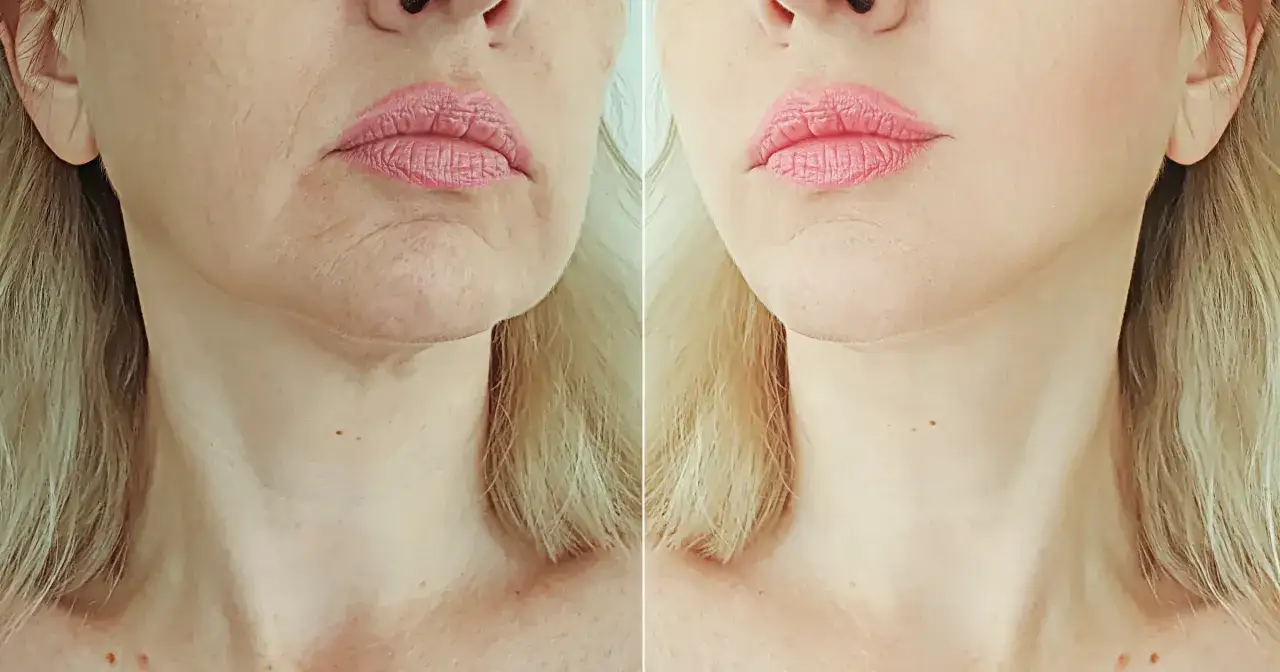 Poznaj prawdziwe przyczyny pomarszczonej skóry i skuteczne sposoby naprawy