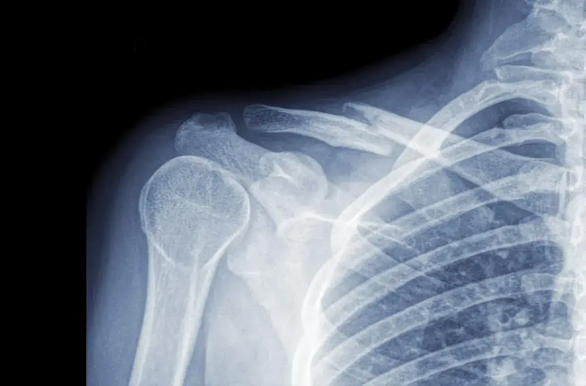 Ile trwa rehabilitacja po złamaniu obojczyka? Poznaj kluczowe informacje