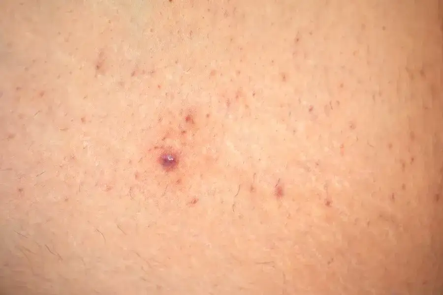 Jak wygląda zapalenie mieszków włosowych? Objawy, przyczyny i leczenie