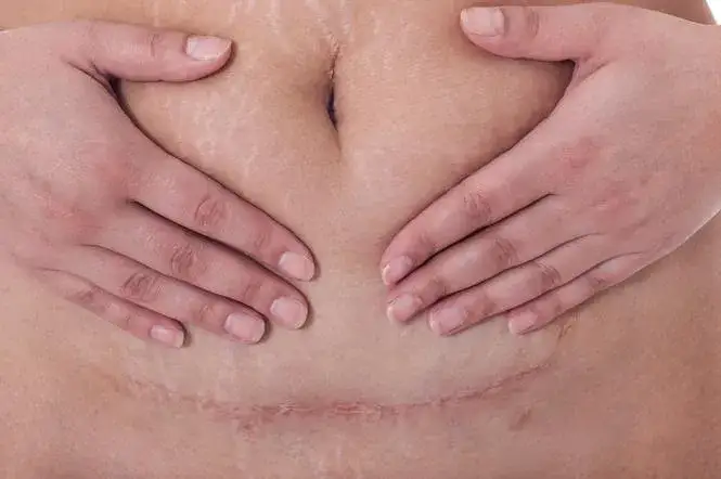 Ból brzucha po cesarce jak długo trwa i kiedy szukać pomocy