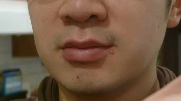 Dlaczego wyciskanie pryszczy jest przyjemne? Poznaj psychologię tej czynności