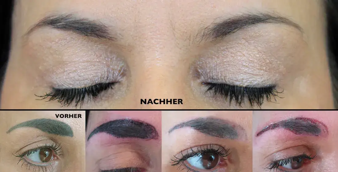 PMU entfernen: Was Sie über Laser, Remover & Kosten wissen müssen