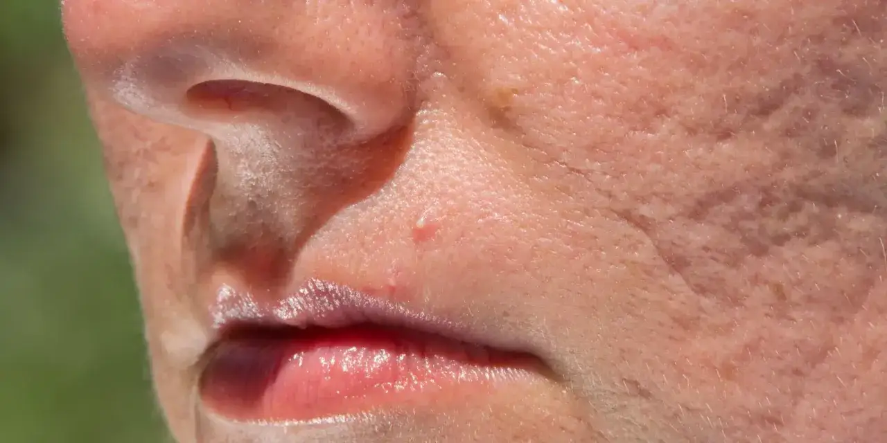 Dlaczego masz pryszcze? Odkryj ukryte przyczyny i skuteczną pomoc.