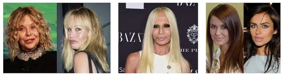 Jak pozbyć się botoksu? Sprawdzone sposoby na skutki uboczne