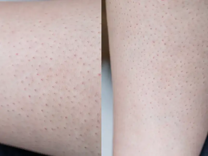 Skóra po depilacji laserowej: Jak wygląda i jak o nią dbać?