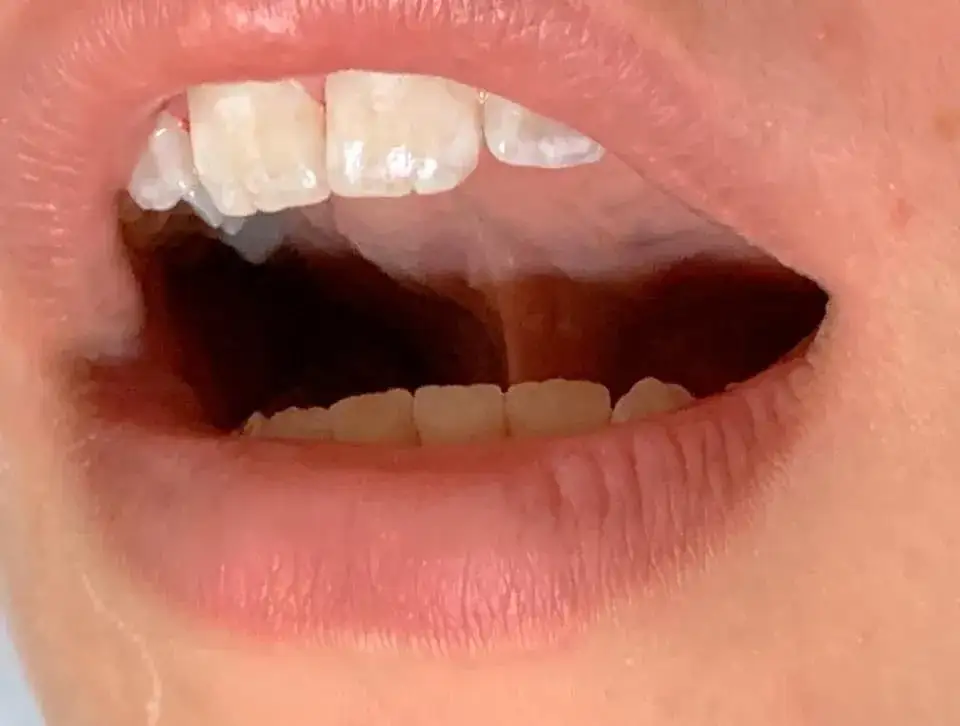 Jak ćwiczyć pozycję spoczynkową języka dla lepszej mowy i zdrowia