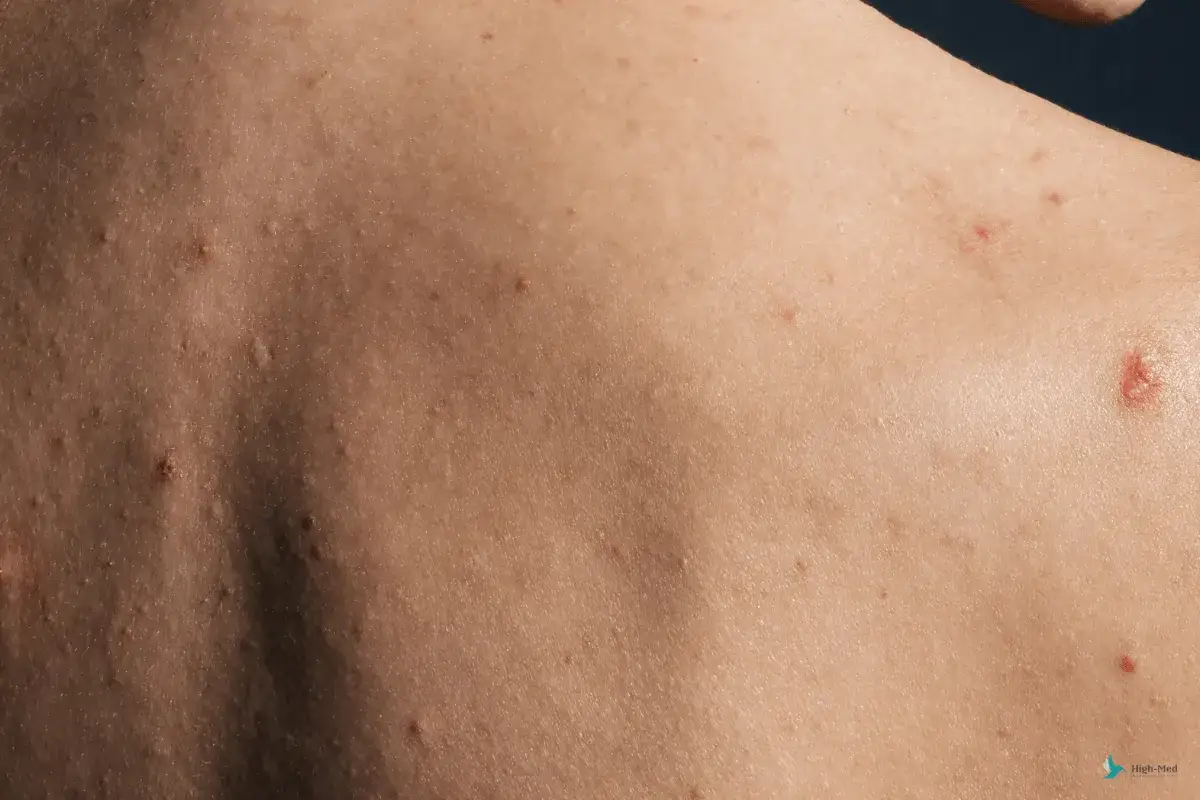 Co na pryszcze na plecach? Od domowych metod po dermatologa