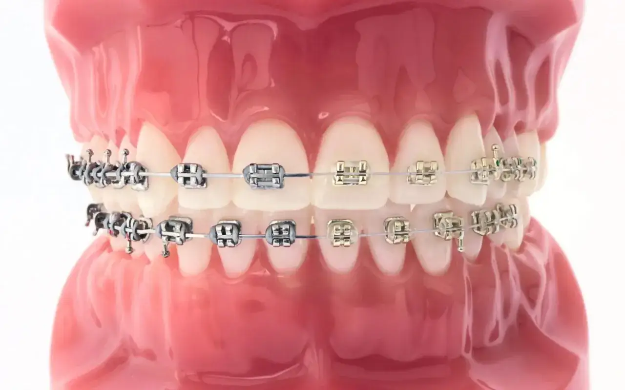 Czy aparat na zęby boli? Jak uniknąć bólu i dyskomfortu podczas noszenia