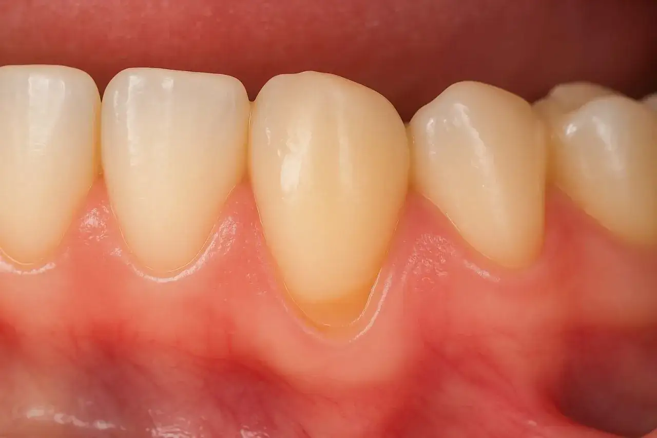 Cofające się dziąsła: jak rozpoznać i skutecznie leczyć? Poradnik