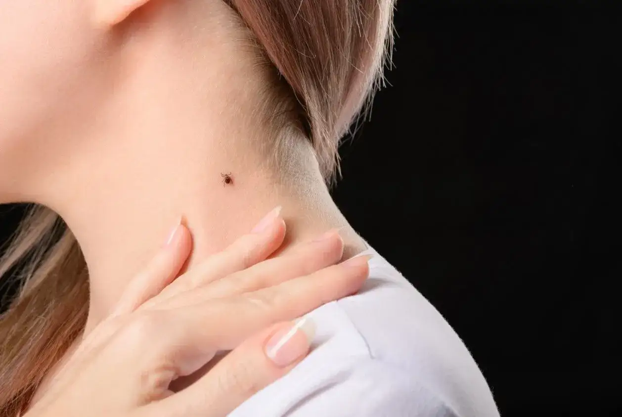 Jak rozpoznać kleszcza na skórze? Odróżnij go od pieprzyka!