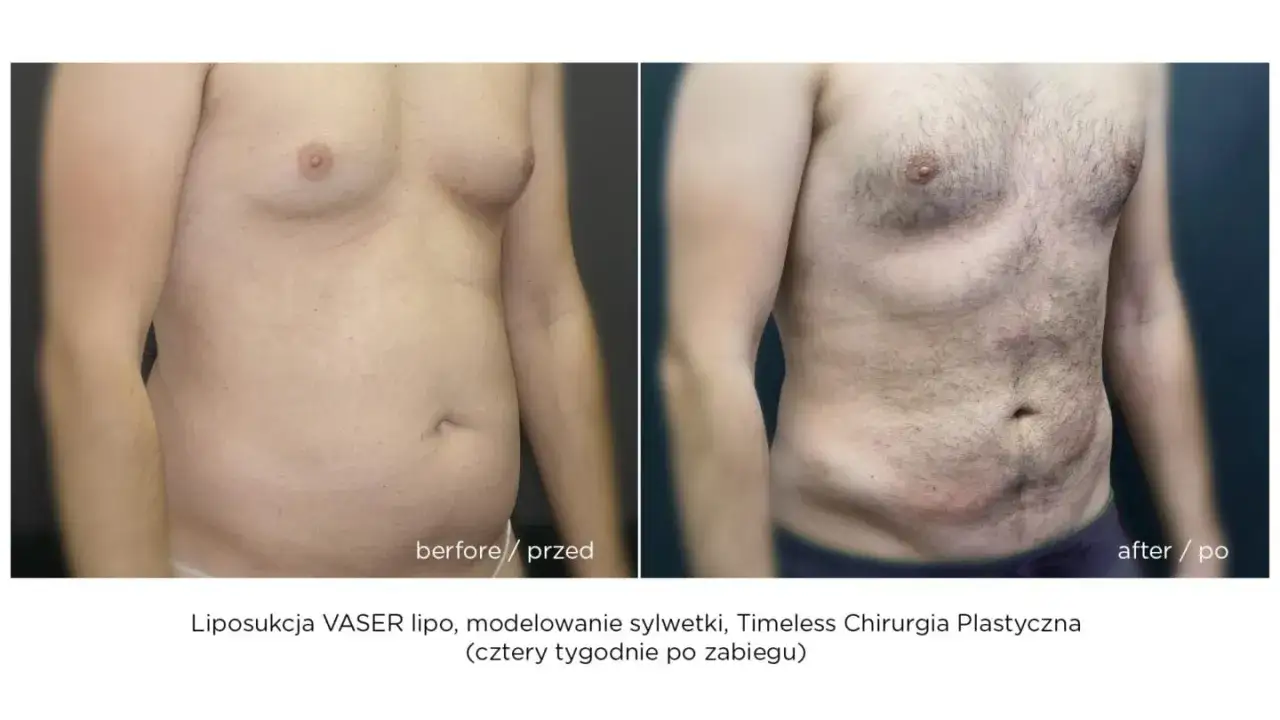 Liposukcja: Modelowanie sylwetki, nie odchudzanie. Poznaj fakty!