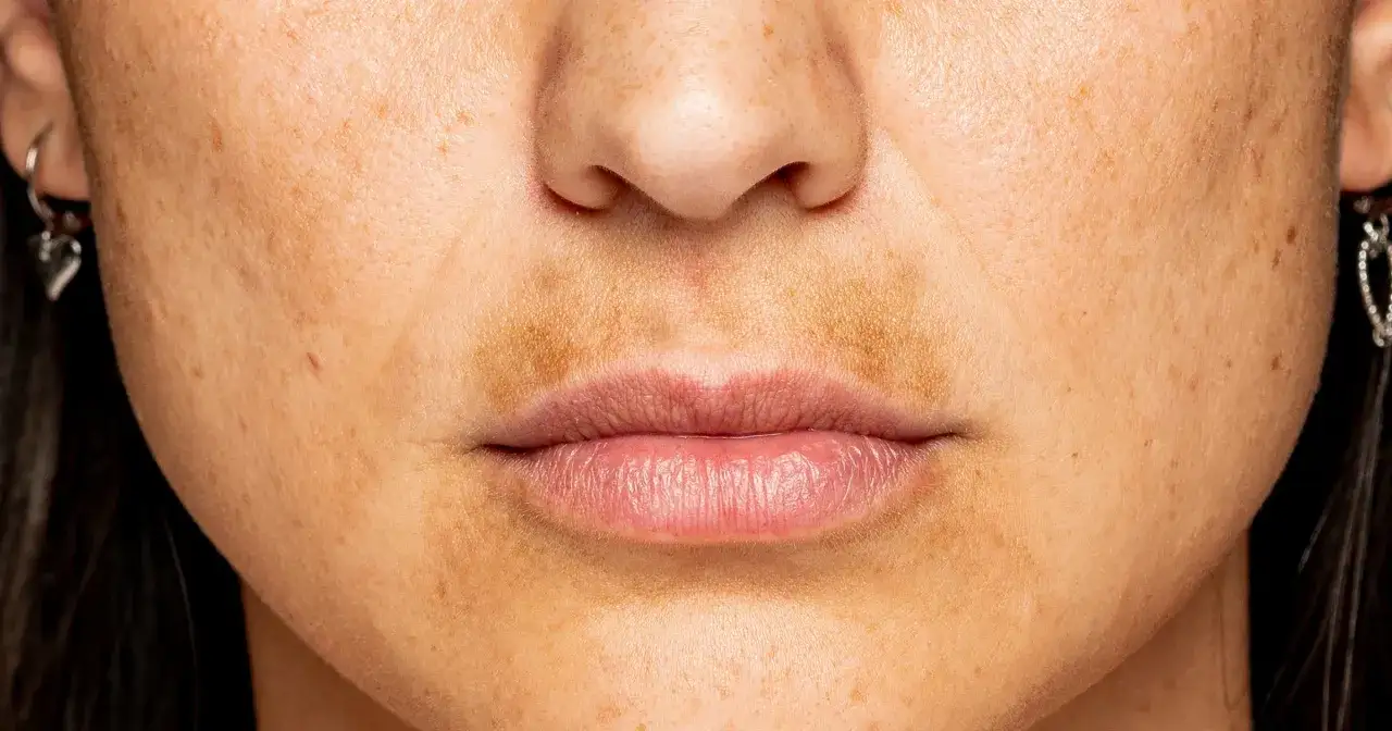 Cera bez przebarwień? Odkryj, jak skutecznie ją rozjaśnić!