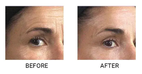 Endermologia twarzy na czym polega - skutki i korzyści zabiegu