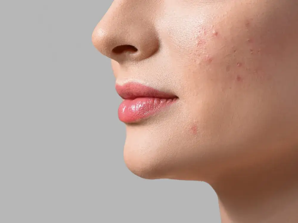 Od czego są pryszcze na brodzie? Poznaj przyczyny i skutki