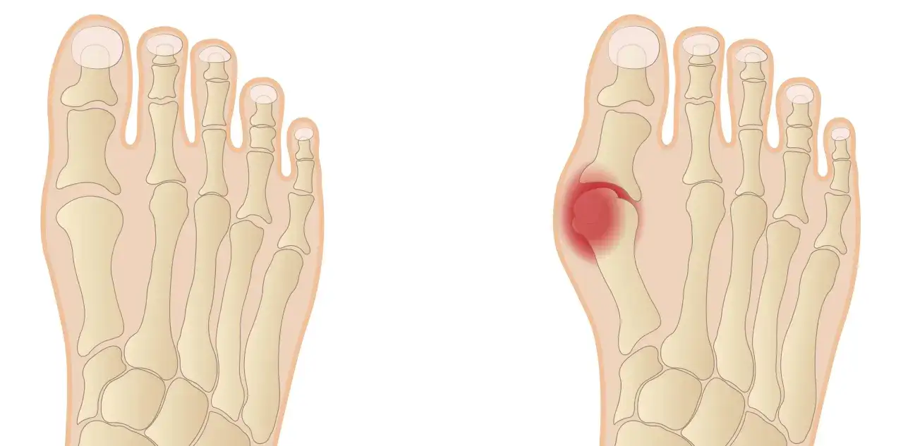 Porównanie anatomii stopy zdrowej i z haluksem, z zaznaczonym bólem.