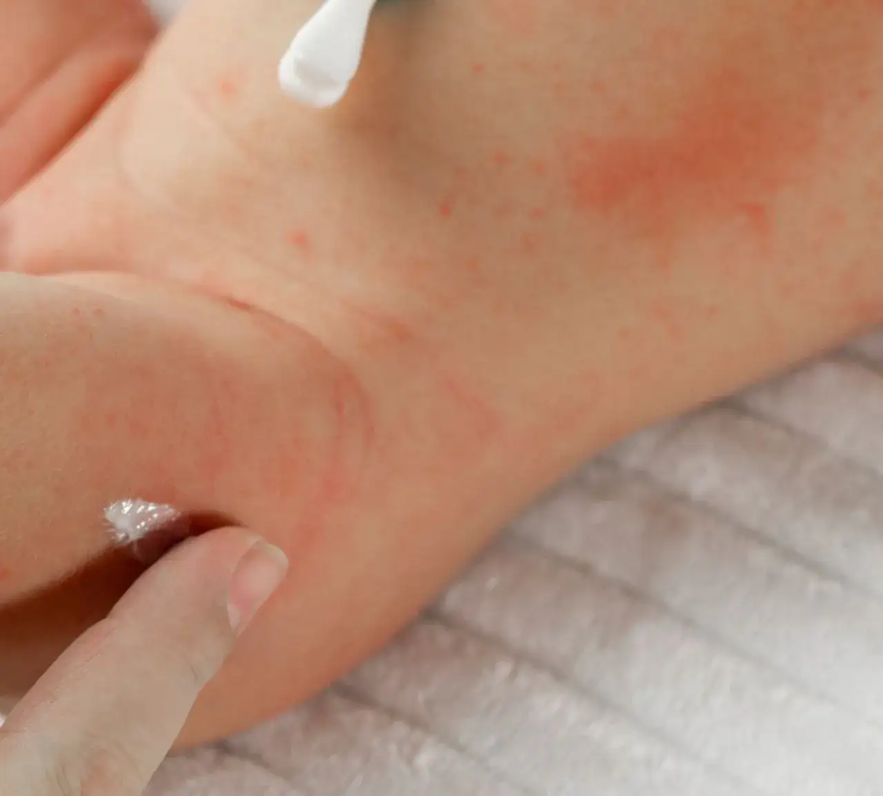 Jak odróżnić potówki od alergii u dziecka - kluczowe różnice