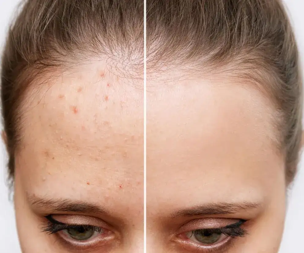 Pryszcze? Skuteczne sposoby na czystą cerę od A do Z!