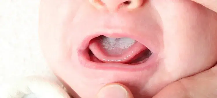 Pleśniawki u niemowlaka: objawy, przyczyny i skuteczne leczenie