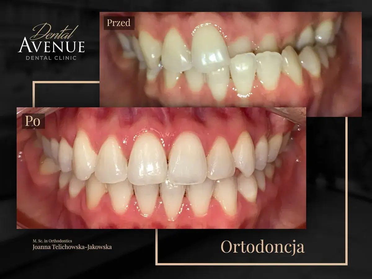 Aparat na zęby: Całkowity koszt leczenia ortodontycznego jak planować?