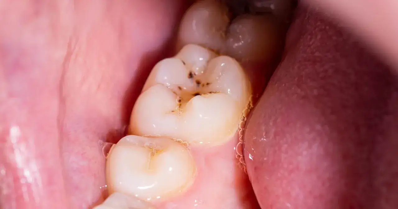 Jak wyleczyć próchnicę w domu? Kiedy to możliwe, a kiedy musisz iść do dentysty?