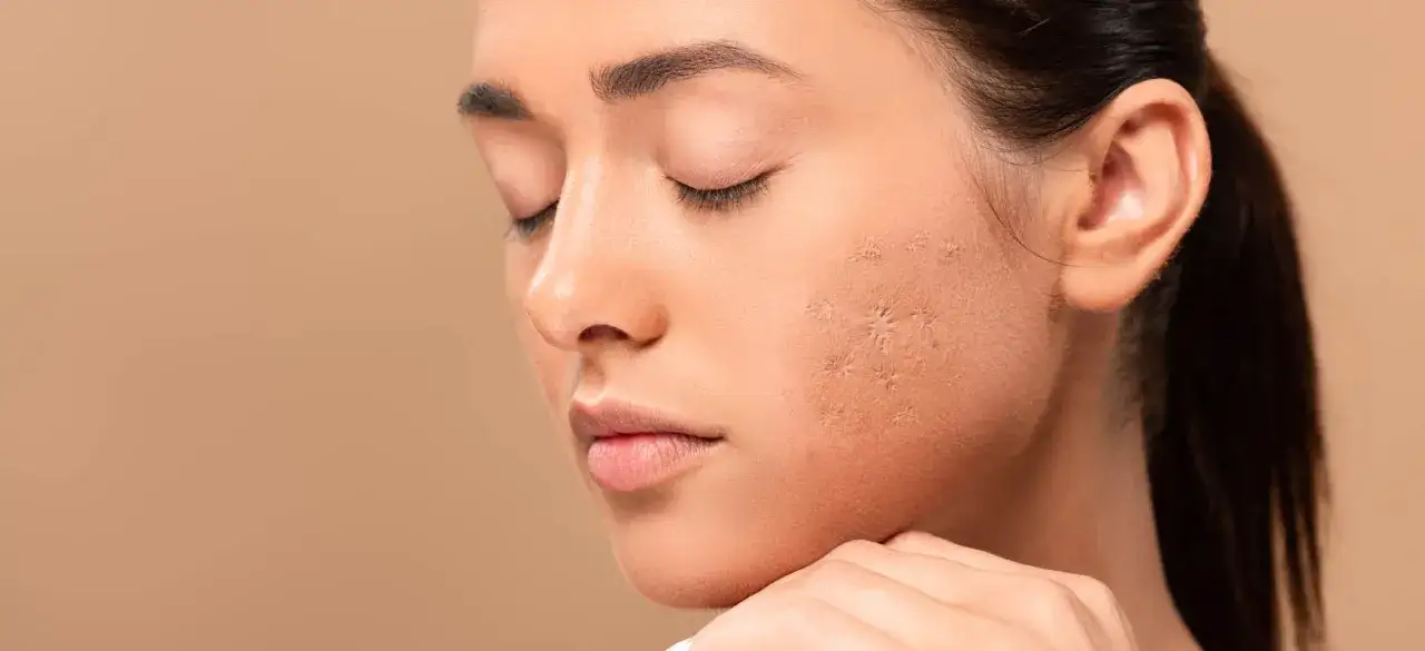 Skuteczne sposoby na blizny po ospie dla dziecka - co warto wiedzieć