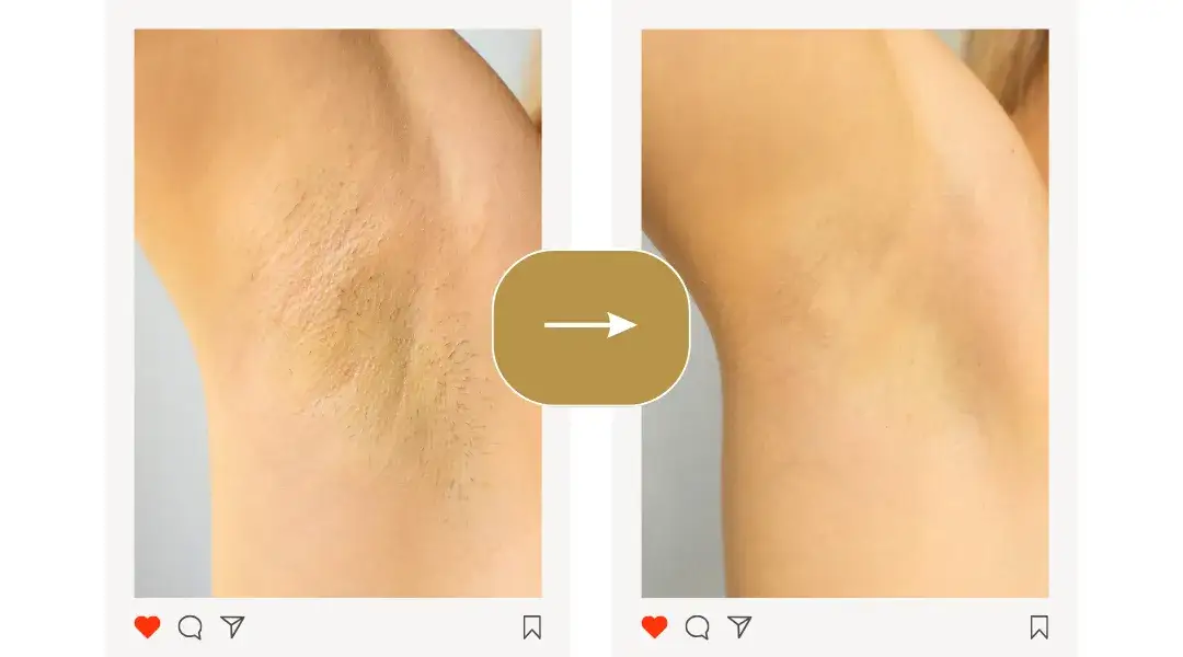 Jak użyć depilatora, aby uniknąć bólu i podrażnień skóry