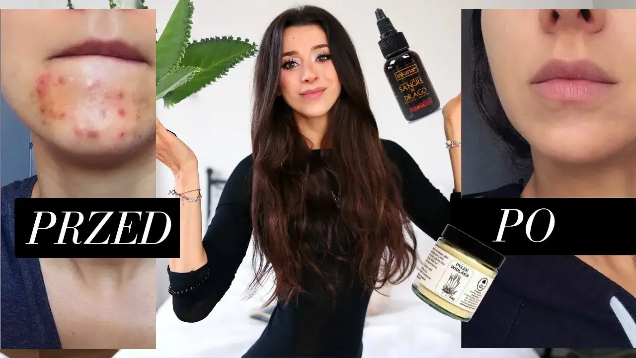 Skuteczne sposoby na to, czym posmarować pryszcza, aby szybko zniknął