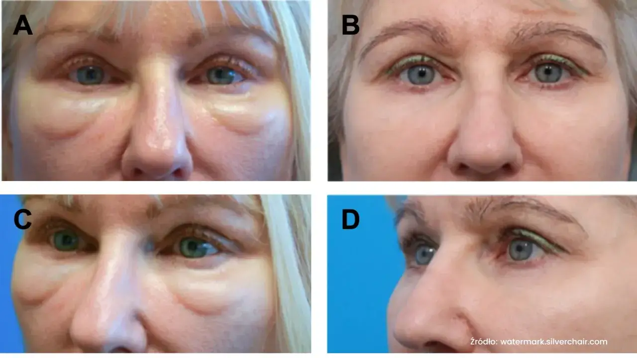 Opadająca powieka po botoksie: Co robić? Szybkie rozwiązania!