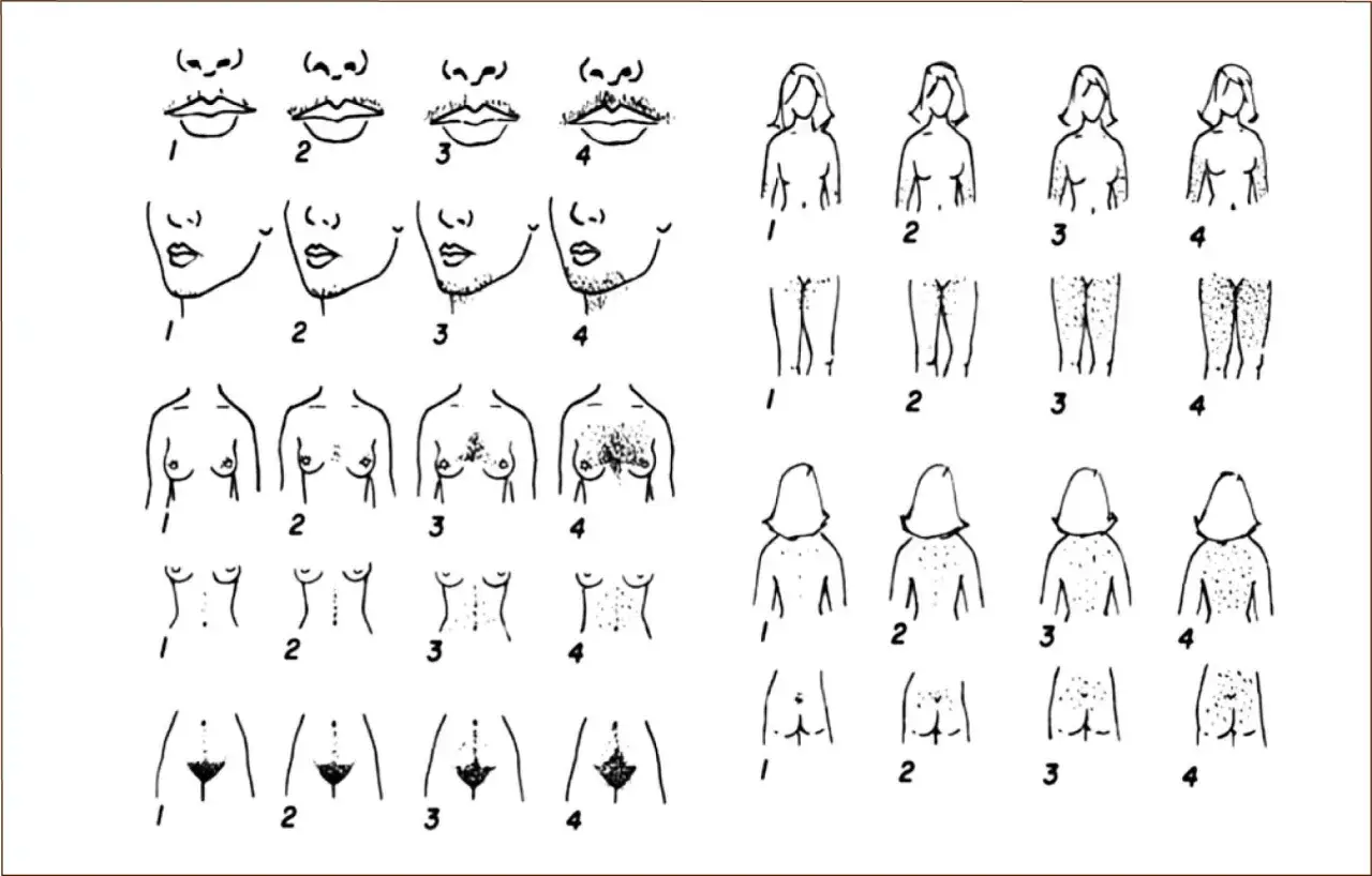SOP: Síntomas clave para detectarlo a tiempo