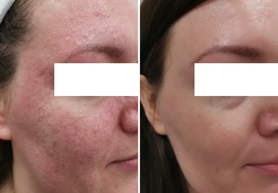 Ile trwa zabieg laserem frakcyjnym i co musisz wiedzieć przedtem