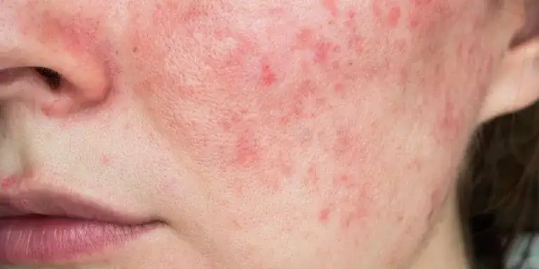 Gerötete Gesichtshaut: Ursachen, Symptome und effektive Behandlungsmöglichkeiten