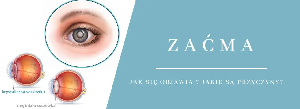 Dlaczego powstaje zaćma? Poznaj przyczyny i jak ich unikać