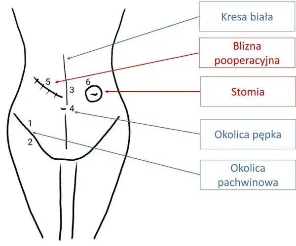 Przepuklina pachwinowa do jakiego lekarza? Kluczowe informacje dla pacjentów