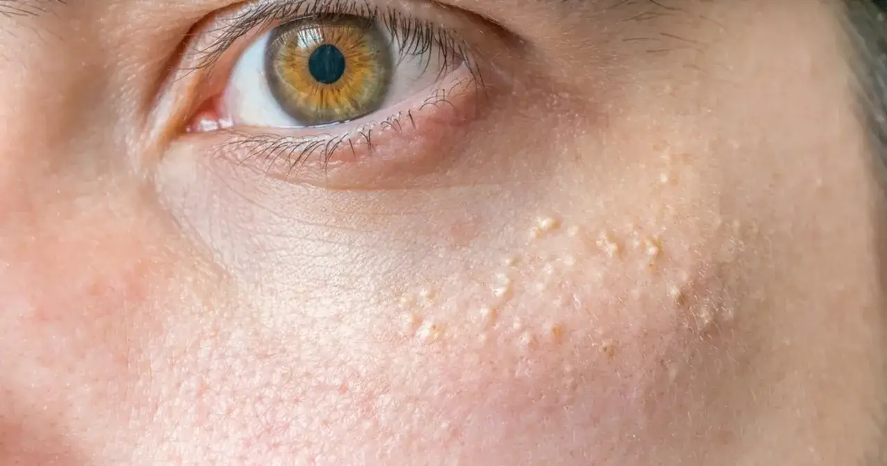 Skuteczne sposoby, jak usunąć pryszcze z twarzy i odzyskać gładką skórę