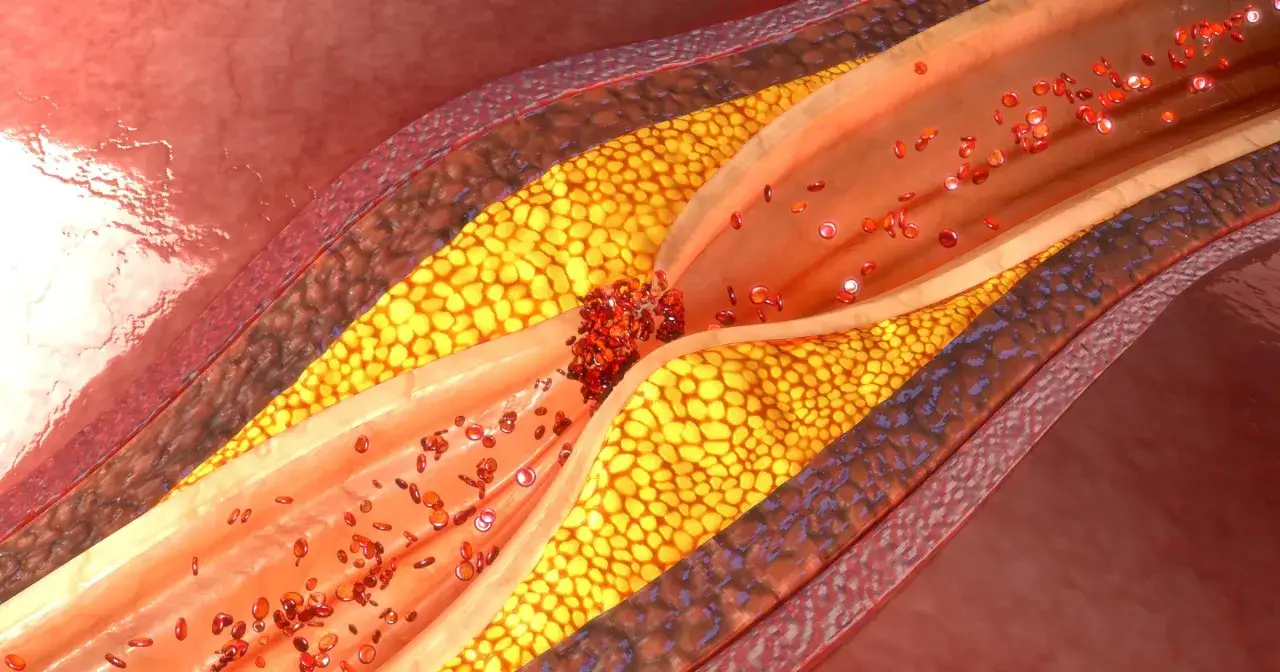 Przekrój naczynia krwionośnego z blaszką miażdżycową. Badanie homocysteiny co to za badanie? Wysoki poziom może prowadzić do takich zmian.