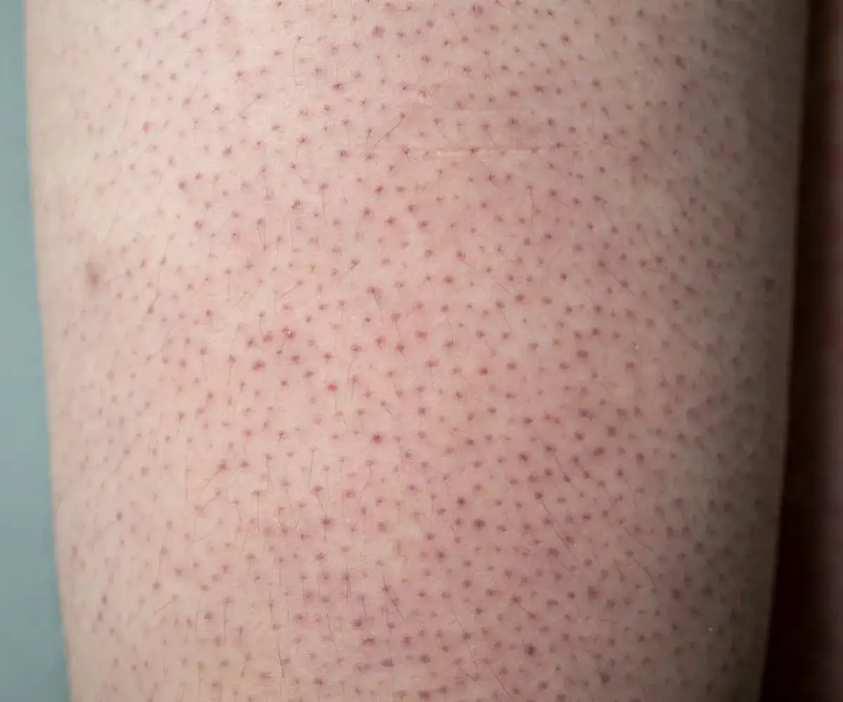 Jak skutecznie pozbyć się truskawkowych nóg i poprawić ich wygląd