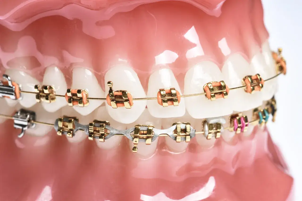 Ile trwa założenie aparatu ortodontycznego? Poznaj każdy etap