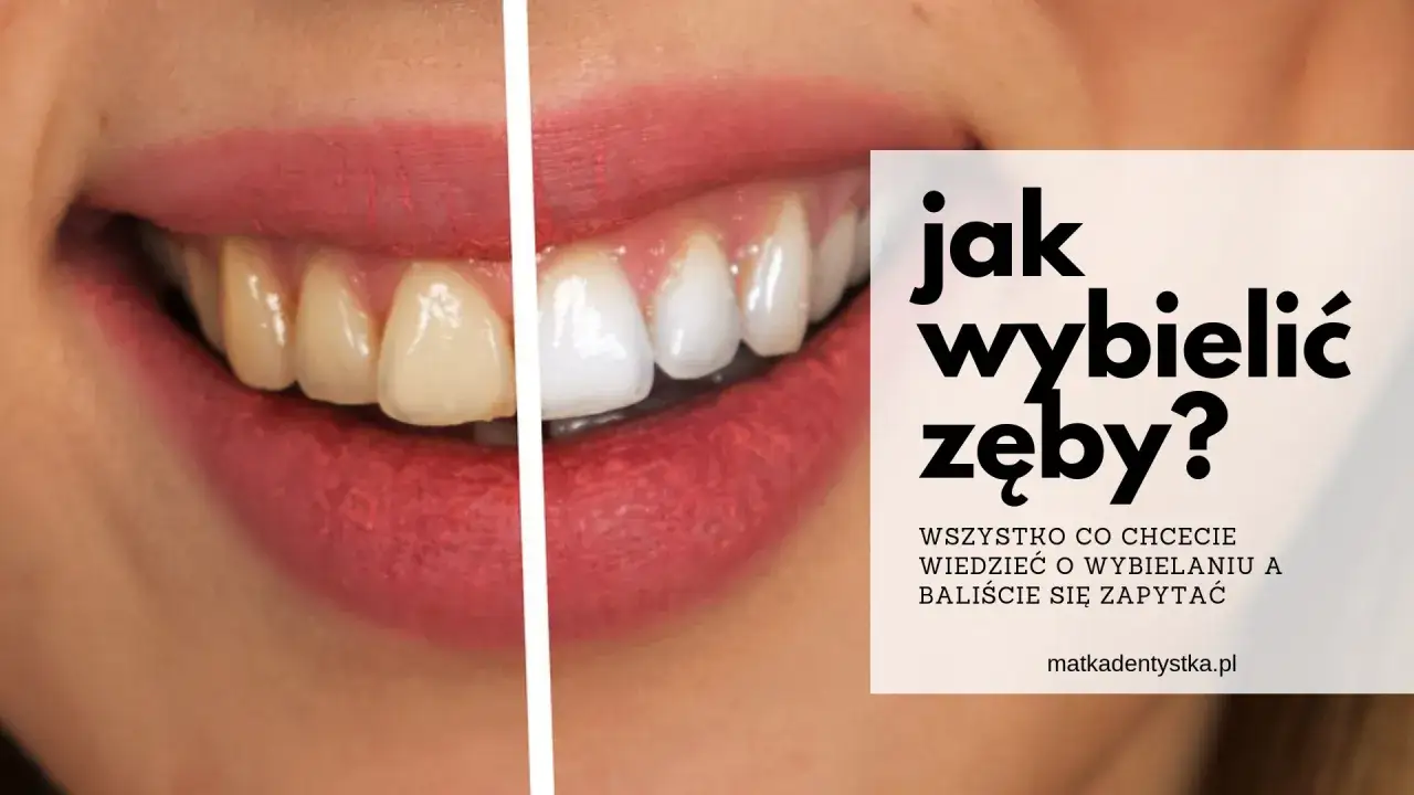 Jak wybielić zęby u dentysty - skuteczne metody i ich koszty