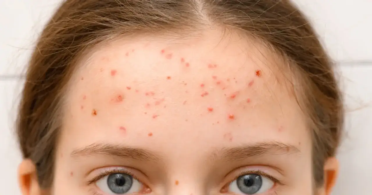 Trądzik młodzieńczy: Jak pokonać pryszcze i odzyskać pewność siebie?