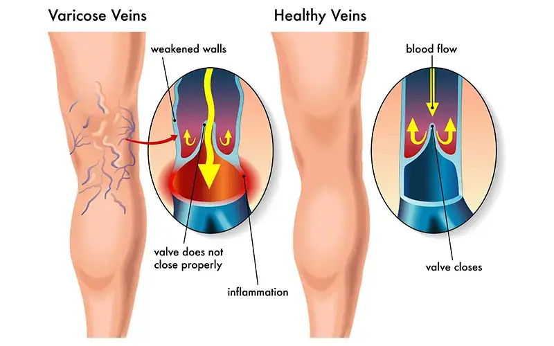 Bein Thrombose Symptome: Warnsignale erkennen & richtig handeln