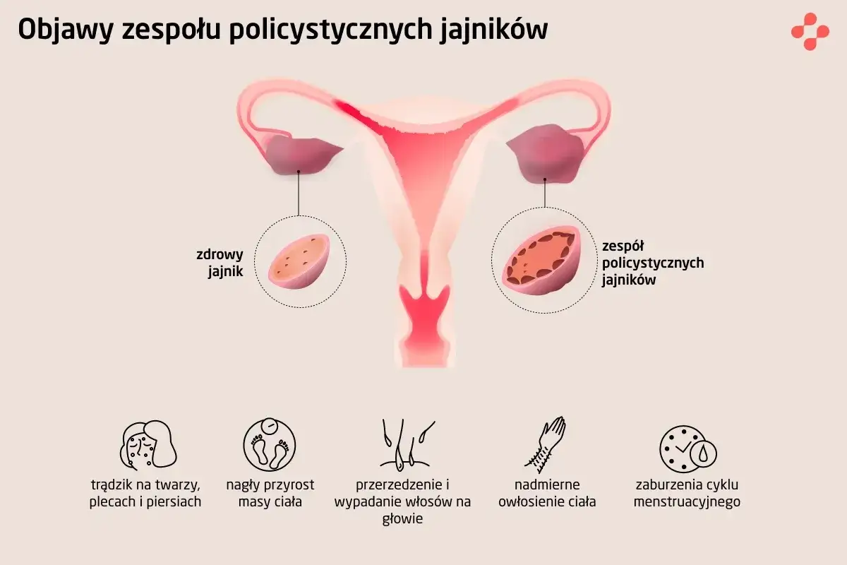 PCOS: Co to jest? Objawy, leczenie i życie z Zespołem Policystycznych Jajników