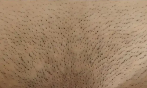 Ile kosztuje depilacja laserowa miejsc intymnych w Warszawie i innych miastach?