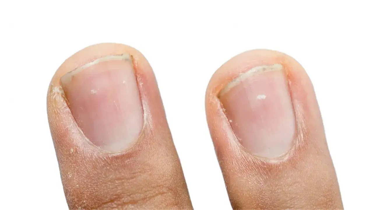 Dwa paznokcie, na jednym widoczne białe plamki, które mogą świadczyć o niedoborze minerałów.