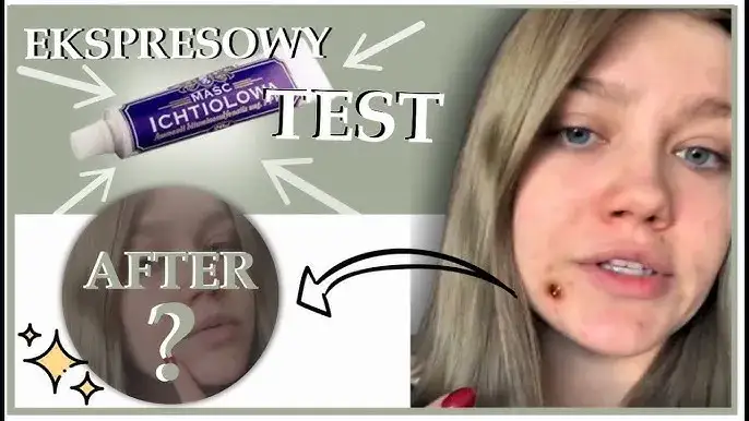 Jak długo trzymać maść ichtiolową na pryszczu? Sprawdź!