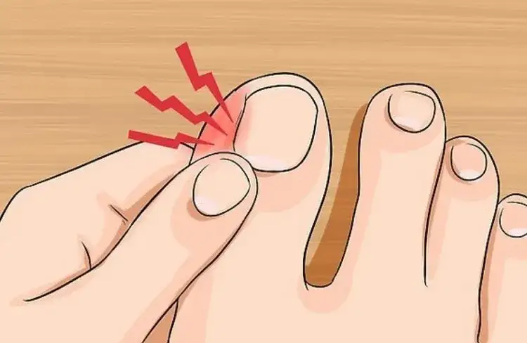 Jak pozbyć się wrastającego paznokcia: skuteczne metody i porady