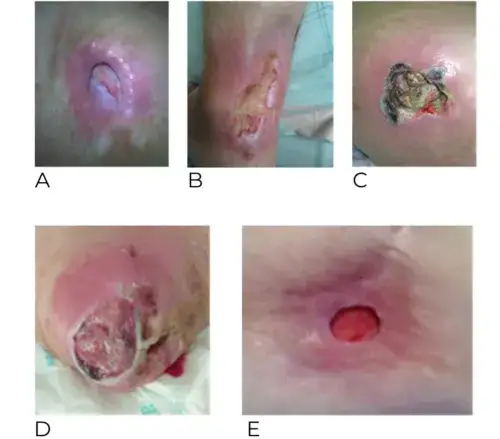 Zakażona krew objawy: jak rozpoznać niebezpieczne symptomy