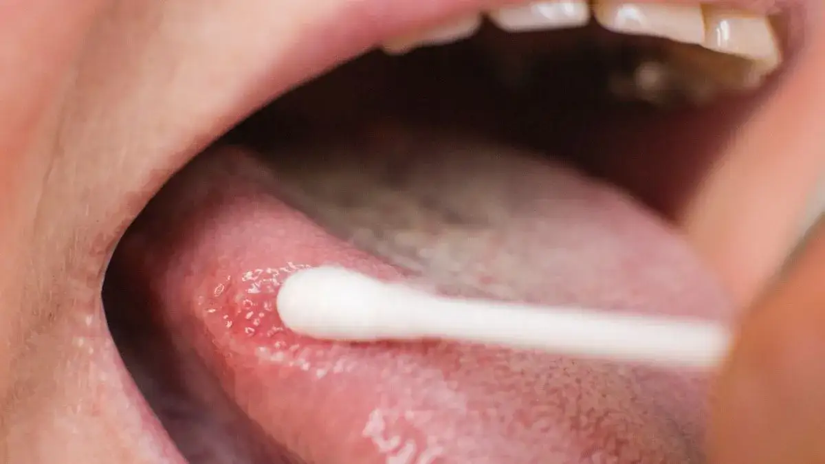 Narośl na języku: do jakiego lekarza się udać? Szybka diagnoza