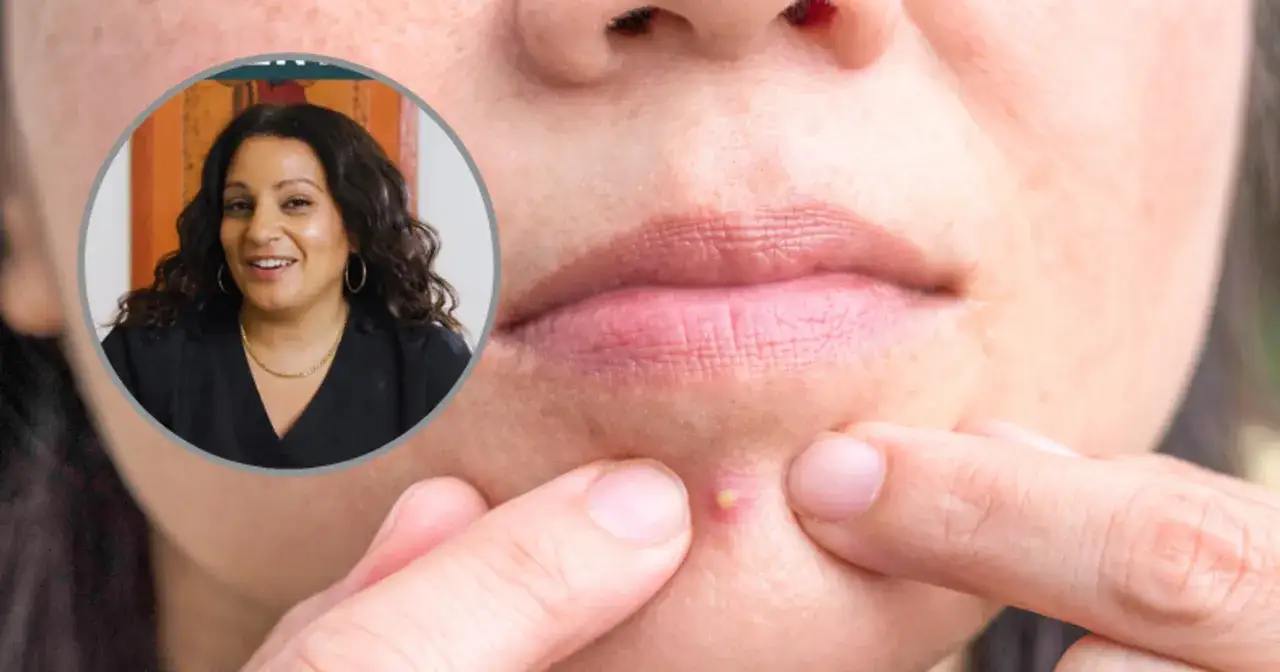 Pryszcz? Pozbądź się go szybko i bezpiecznie! Rady eksperta.